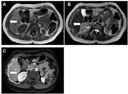 Thoracic computed tomography findings in malignant mesothelioma. Magnetic Resonance Imaging Mri Of A Patient With Malignant Pleural Download Scientific Diagram