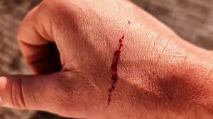 Cut bleeding blood coming out hand wrist pain hand up-close first air  bruise hurt in pain