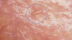 Image result for Demodex folliculorum