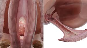 Image result for Candidiasis