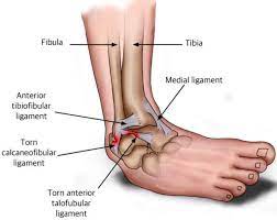 Ankle Ligament Sprain Germantown & Collierville - Pittman Pt