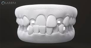 However, each patient is different, which is why it's important to schedule an appointment with one of our invisalign orthodontists. What Are Invisalign Attachments And When Are They Needed