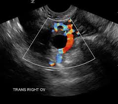 The annual incidence of ovarian cancer globally is 204,000. Gynecology Pelvic Ultrasound Made Easy Step By Step Guide Pocus 101