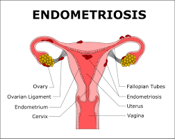 Treatment of endometriosis and chronic pelvic pain with letrozole and norethindrone acetate: Endometriosis Nutritional Therapist Tavistock Devon And The South West Fiona Waring