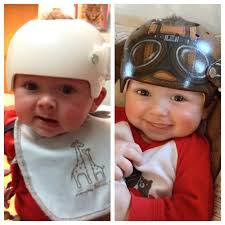 Artist Turns Babies Head Shaping Helmets Into Impressive Works Of Art Love The Aviator Caps Baby Helmet Children S Medical Helmet