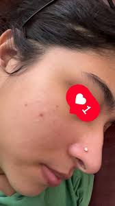 What can i use for these red acne marks?Been suffering for a lot of days  for these post acne marks