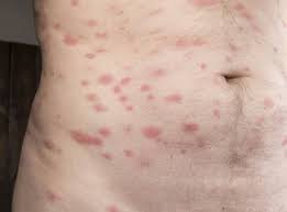 Image result for bedbug bites look like