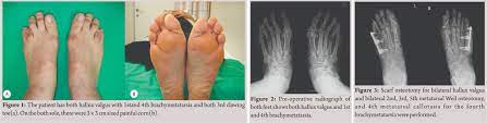 Long Term Result Of Weil Osteotomy And Callotasis For Bilateral Brachymetatarsia A Case Report Journal Of Orthopaedic Case Reports
