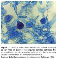 Vista De Infeccion Orofacial Por Conidiobolus Coronatus Biomedica