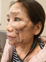 Department of Burns and Plastic Surgery has successfully reconstructed a  large facial defect using Free Fibula Osteocutaneous Flap (from leg) in a  70 year old female patient with Oral Cancer involving mandible (