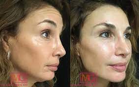 Maybe you would like to learn more about one of these? Botox Eyebrow Lift Forehead Lines Glabella Area