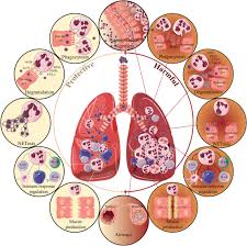 Help protect yourself and your loved ones from rsv infection. Neutrophils In Respiratory Syncytial Virus Infection From Harmful Effects To Therapeutic Opportunities Tahamtan 2021 British Journal Of Pharmacology Wiley Online Library