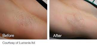 Although the effects last longer than home hair. Diode Alexandrite Laser Hair Removal System For All Skin Types
