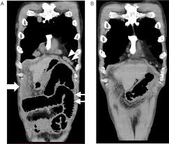 Maybe you would like to learn more about one of these? Nivolumab For Malignant Peritoneal Mesothelioma Bmj Case Reports