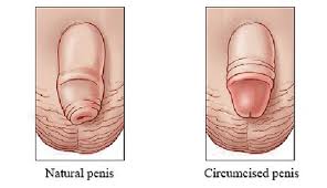 Maybe you would like to learn more about one of these? Circumcision What You Need To Know Advanced Urology