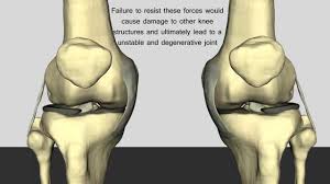 We did not find results for: Anterior Cruciate Ligament Acl Physiopedia