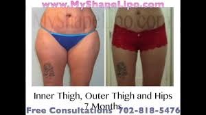 Thighs Liposuction Inner Thigh Outer Thigh Full Thigh Before And After Myshape Lipo Is Giving Away Three Fre Thigh Liposuction Outer Thighs Liposuction