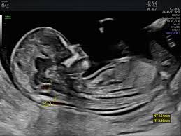 Image result for First Trimester Ultrasound