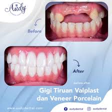 Gigi palsu akrilik adalah gigi palsu yang diletakkan dalam acuan resin akrilik berwarna merah jambu atau warna gusi. Gigi Tiruan Lepasan Audy Dental