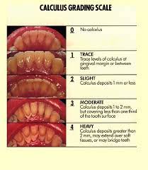 Calculus Grading Scacle Calculus Tartar Dental Dental Dental Hygiene Student Dental Assistant Study