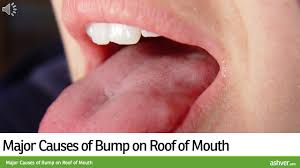 I just ate garlic bread, so i'm i have 2 bumps on the right side of the roof of my mouth, one has been there about a day longer than the today, i noticed several tiny bumps on my soft palate. Bump On Roof Of Mouth Definition Symptoms Causes Treatment And More Ricearch Com