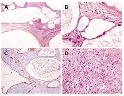 Benign multicystic peritoneal mesothelioma is a rare benign tumor that presents with recurrent peritoneal mesothelial cysts that arise from the epithelial and . Benign Multicystic Peritoneal Mesothelioma A Case Report And Review Of The Literature
