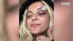 Bebe Rexha posts new video of injuries after being hit by phone
