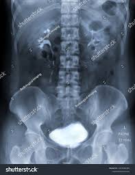 Image result for Intravenous Pyelogram
