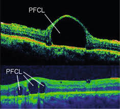 Vitreous fluid flows through a retinal tear to cause a partial retinal detachment involving the macula. New Landmarks Signs And Findings In Optical Coherence Tomography Intechopen