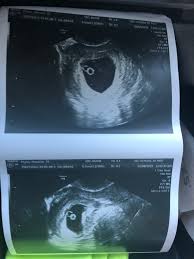 Jetzt timeblock® ganz einfach bei douglas bestellen und 2 gratisproben sichern! 5 Week Scan With Twins Multiples And Twins Forums What To Expect