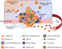 Cancer has spread to organs and tissues outside the abdomen, including lymph nodes in the groin. The Hallmarks Of Ovarian Cancer Focus On Angiogenesis And Micro Environment And New Models For Their Characterisation Sciencedirect