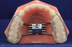 What To Expect With Your Child S Orthodontic Expander By Dr Greg Jorgensen By Dr Greg Jorgensen Serving Albuque Orthodontics Dental Braces Dental Retainer