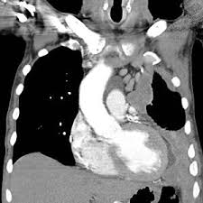 Pleural thickening is a disease that can be caused by asbestos exposure. Mesothelioma Wikipedia