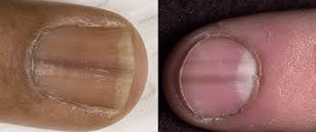 Franja De Color Marron Claro En La Una Enfermedades De Las Que Te Pueden Informar Tus Unas Cuales Son Las Rayas En Las Unas De Las Manos Y Los Pies