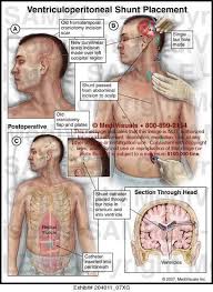 Pin On Cure Chiari