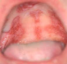 La infección se desarrolla a consecuencia de la inhalación de esporas hacia los senos. Ulceras Orales Piel Formacion Continuada En Dermatologia