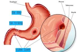 Hầu hết những vết loét của bệnh nhân viêm loét dạ dày đều có thể liền sẹo sau khoảng 8 tuần. Viem Loet Dáº¡ Day La Bá»‡nh Gi