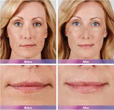 Maybe you would like to learn more about one of these? Juvederm Ultra Lip Fillers In Grand Rapids Urban You Modern Beauty Wellness