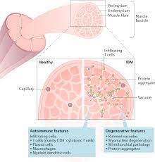 A rare necrotizing soft tissue infection involving muscle. Inclusion Body Myositis Clinical Features And Pathogenesis Nature Reviews Rheumatology