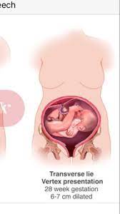 Transverse Breech Lie Advice Babycentre