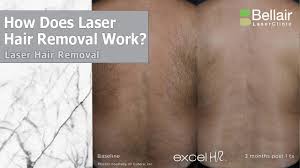 Laser hair removal procedure has now become a common solution to get rid of unwanted body hair. Laser Hair Removal Toronto