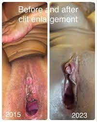 Before and after my clit enlargement : r/GrowYourClit