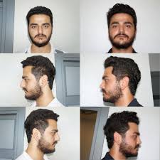 Whatsapp For English 00905413863535 My Dear Patient Burak Is Going To Enter His 2nd Year After Surgery We Operated On Burak And His Sister M Rinoplasti