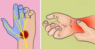 Bisakah anda mengendarai sepeda saat hamil? Penyebab Dan Solusi Carpal Tunnel Syndrome Yang Rasanya Seperti Kesemutan Di Tangan Jangan Dikit Dikit Dihubungkan Dengan Covid 19 Semua Halaman Grid Health