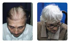 صور استعادة الشعر للنساء عيادة كوزمسيرج لزراعة الشعر في دبي