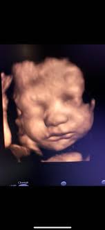 26 weeks +3 cervix is completely thinned out but baby boy is hanging in  there 🙏🏾