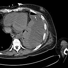 Pleural effusion is the accumulation of fluid in the pleural space resulting from disruption of the a loculated pleural effusion is the major radiographic hallmark of parapneumonic effusion or empyema (see fig. Ct Scan Of The Chest Showing The Loculated Left Pleural Fluid Download Scientific Diagram