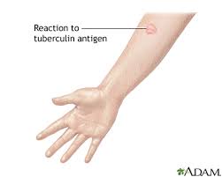 Tuberculosis (tb) in healthcare settings Tuberculin Skin Test Medlineplus Medical Encyclopedia Image