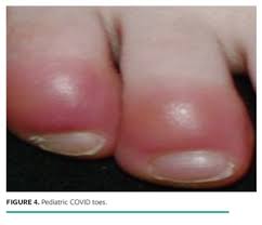 Cutaneous Manifestation During Covid 19 Don T Let The Rash Fool You Wound Management Prevention