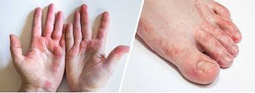 Image result for Atopic eczema atopic dermatitis